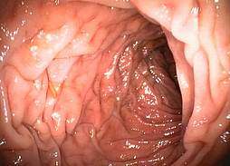 Video endoscopy colon