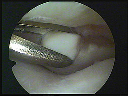 Removal of a bone chip using arthroscopy